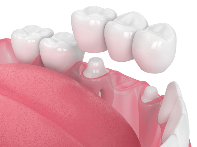 Dental illustration of an upper jaw section showing teeth with crowns on dental implants, with visible gums and metal posts embedded in gum tissue.