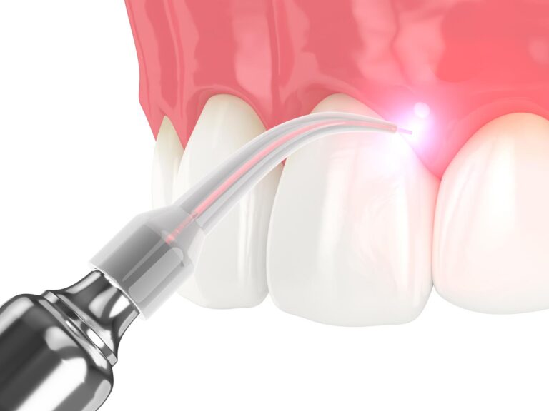 dental diode laser
