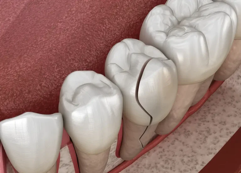 Cracked Tooth Repair in Prince Frederick, MD at Calvert Dentistry